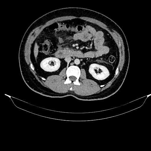 File:Acute pancreatitis (Radiopaedia 87428-103757 Axial C+ portal venous phase 46).jpg