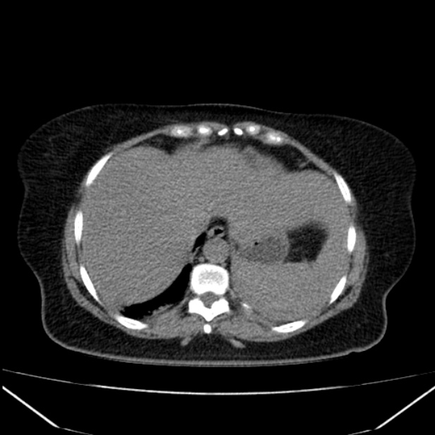 Acute pancreatitis - Balthazar C (Radiopaedia 26569-26714 Axial non-contrast 18).jpg