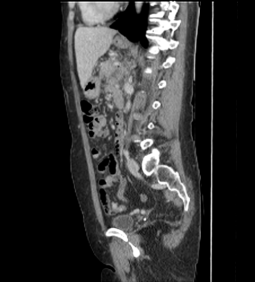 File:Acute pancreatitis - Balthazar E - post ERCP (Radiopaedia 27562-27772 Sagittal C+ portal venous phase 80).png