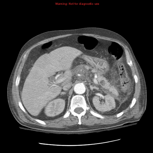 Acute pancreatitis with incidental pancreatic lipoma (Radiopaedia 10190-10730 Axial C+ arterial phase 32).jpg