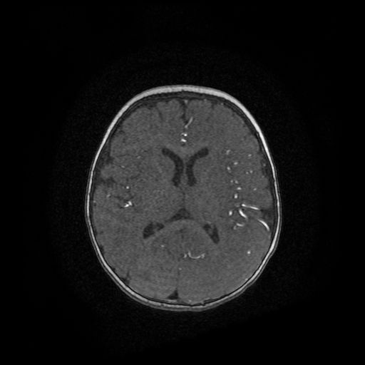 Acute phase of hemiconvulsion-hemiplegia epilepsy syndrome (Radiopaedia 29309-29745 Axial TOF angiography 41).jpg