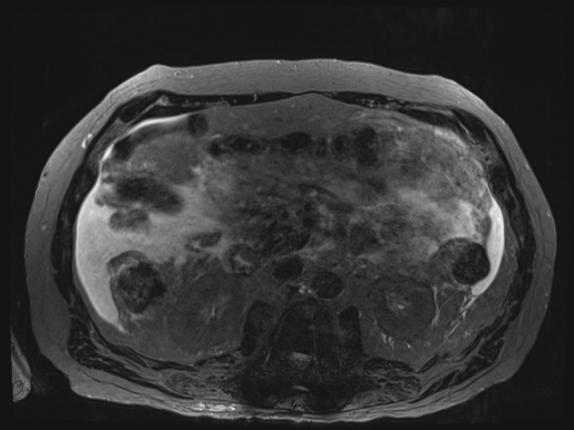Acute portal vein thrombosis (Radiopaedia 73198-83925 Axial Heavily T2 thin cuts 54).jpg