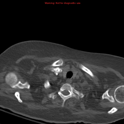 Acute pulmonary embolism (Radiopaedia 13286-13289 Axial C+ CTPA 6).jpg