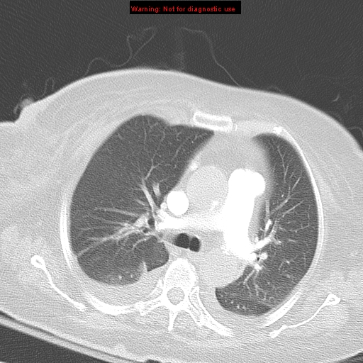 File:Acute pulmonary embolism (Radiopaedia 13286-13289 B 17).jpg