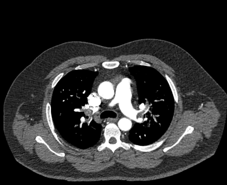 Acute pulmonary embolism with pulmonary infarcts (Radiopaedia 77688-89908 Axial C+ CTPA 22).jpg