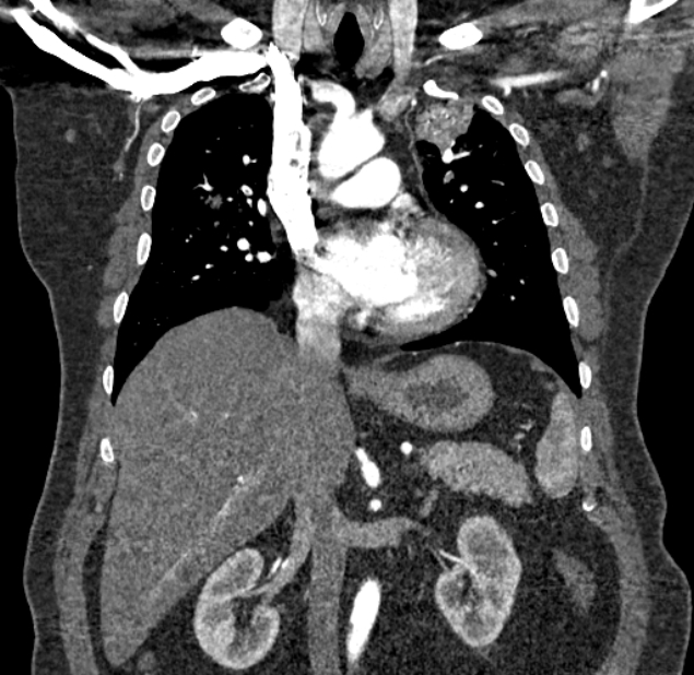 Acute pulmonary embolism with pulmonary infarcts (Radiopaedia 77688-89908 Coronal C+ CTPA 40).jpg