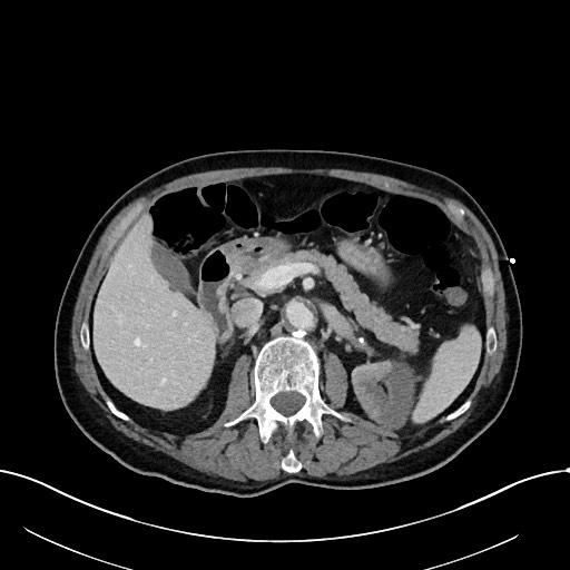 Acute renal infarction (Radiopaedia 59375-66736 Axial C+ portal venous phase 34).jpg