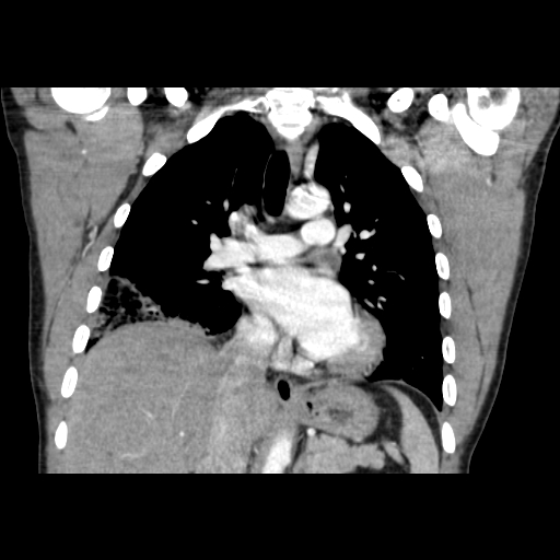 File:Acute segmental pulmonary emboli and pulmonary infarction (Radiopaedia 62264-70444 Coronal C+ CTPA 26).jpg