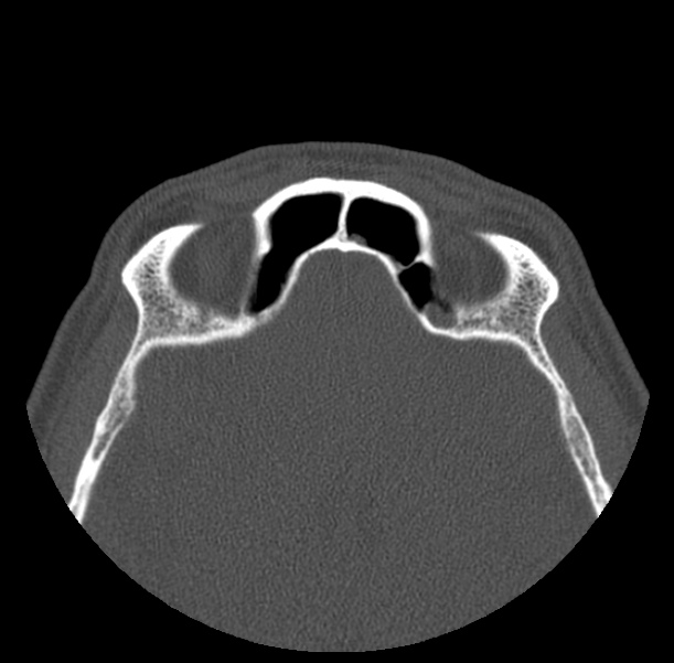 Acute sinusitis (Radiopaedia 23161-23215 Axial bone window 63).jpg