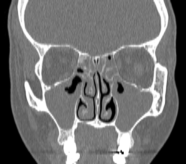 Acute sinusitis (Radiopaedia 40564-43158 Coronal bone window 19).jpg