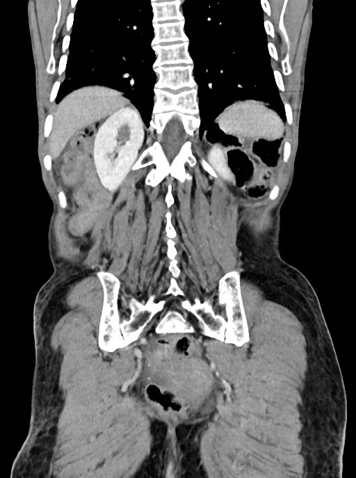Acute small bowel (ileal) volvulus (Radiopaedia 71740-82139 Coronal C+ portal venous phase 89).jpg