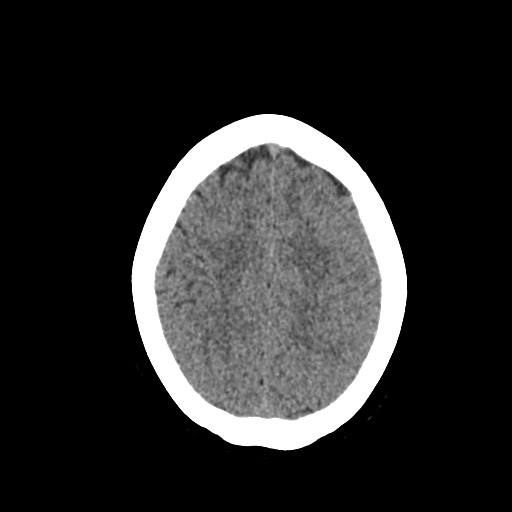Acute subarachnoid hemorrhage and accessory anterior cerebral artery (Radiopaedia 69231-79008 Axial non-contrast 42).jpg
