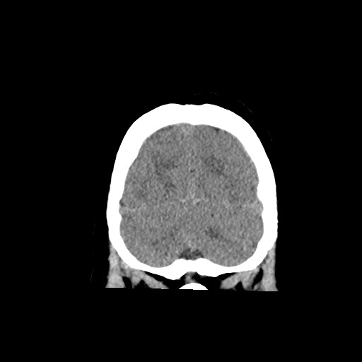 Acute subarachnoid hemorrhage and accessory anterior cerebral artery (Radiopaedia 69231-79008 Coronal non-contrast 61).jpg