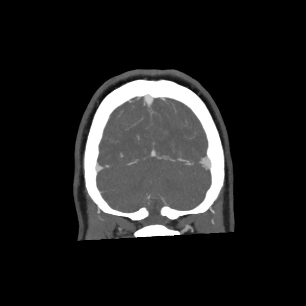 Acute subarachnoid hemorrhage and accessory anterior cerebral artery (Radiopaedia 69231-79009 Coronal C+ arterial phase 70).jpg
