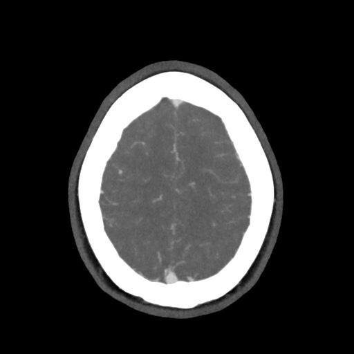 Acute subarachnoid hemorrhage and accessory anterior cerebral artery (Radiopaedia 69231-79009 D 58).jpg