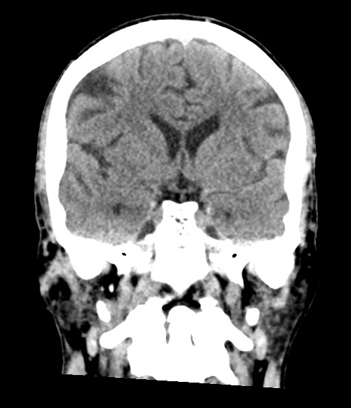 Acute superior cerebellar artery territory infarct (Radiopaedia 84104-99359 Coronal non-contrast 46).jpg