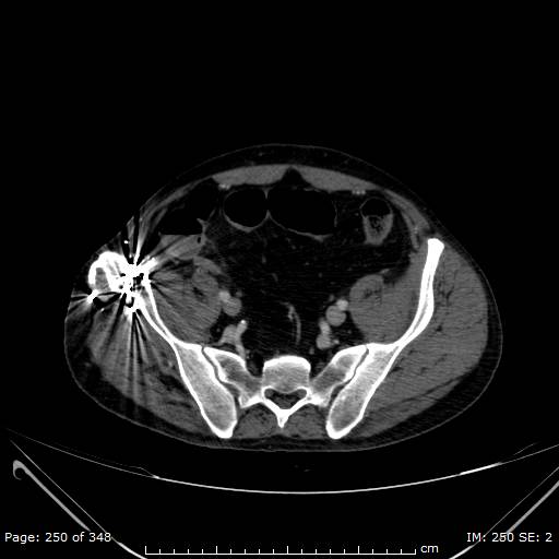 Acute superior mesenteric artery occlusion (Radiopaedia 43636-47060 Axial C+ portal venous phase 48).jpg