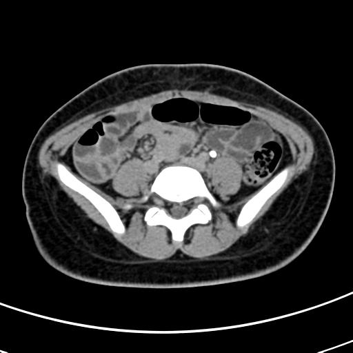 File:Acute suppurative pyelonephritis (Radiopaedia 18306-18147 Axial renal excretory phase 110).jpg