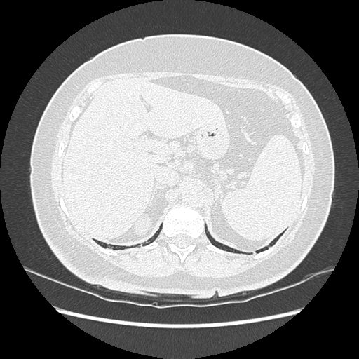 Adenocarcinoma in situ of lung (Radiopaedia 38685-40829 B 215).png