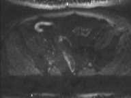 Adenocarcioma of rectum- T1 lesion (Radiopaedia 36921-38546 Axial DWI 20).png