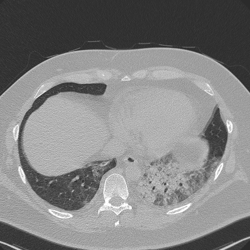 Adenoid cystic carcinoma of the trachea (Radiopaedia 49042-54137 Axial lung window 266).jpg