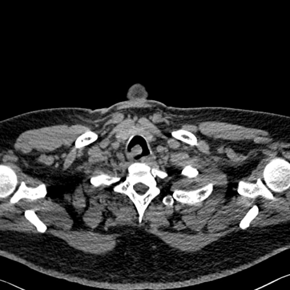 File:Adenoid cystic carcinoma of the trachea (Radiopaedia 49042-54137 Axial non-contrast 15).jpg