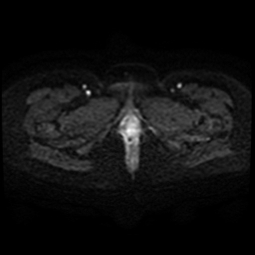 Adenoma malignum of cervix (Radiopaedia 66441-75705 Axial DWI 51).jpg