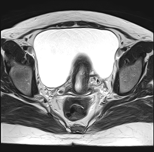 File:Adenomyosis - ovarian endometriomas (Radiopaedia 67031-76350 Axial T2 18).jpg