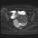 File:Adenomyosis and endometriotic cysts (Radiopaedia 82300-96367 Axial DWI 9).jpg