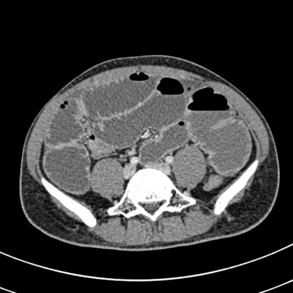 Adhesional small bowel obstruction (Radiopaedia 52107-57980 Axial C+ portal venous phase 83).jpg