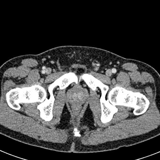 Adhesional small bowel obstruction (Radiopaedia 58900-66131 Axial C+ portal venous phase 53).jpg