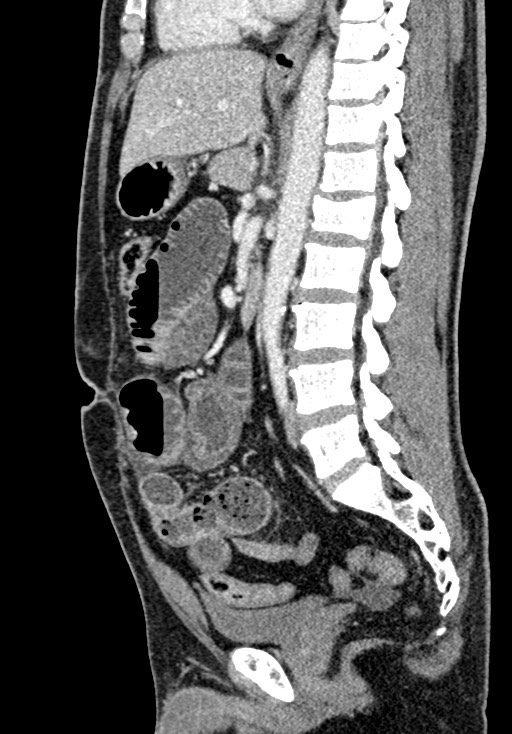 Adhesional small bowel obstruction (Radiopaedia 58900-66131 Sagittal C+ portal venous phase 134).jpg