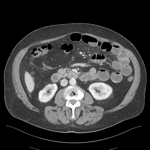 Adhesions within abdominal wall hernia (Radiopaedia 58283-65394 Axial C+ portal venous phase 40).png