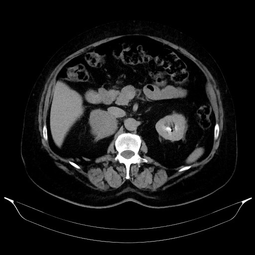 File:Adrenal cortical carcinoma (Radiopaedia 64017-72769 Axial C+ delayed 28).jpg