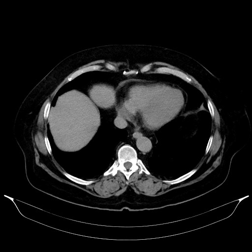 Adrenal cortical carcinoma (Radiopaedia 64017-72769 Axial C+ delayed 8).jpg