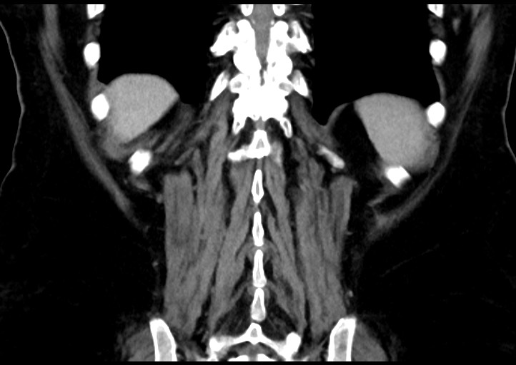 Adrenal cortical carcinoma (Radiopaedia 64017-72769 Coronal C+ portal venous phase 45).jpg