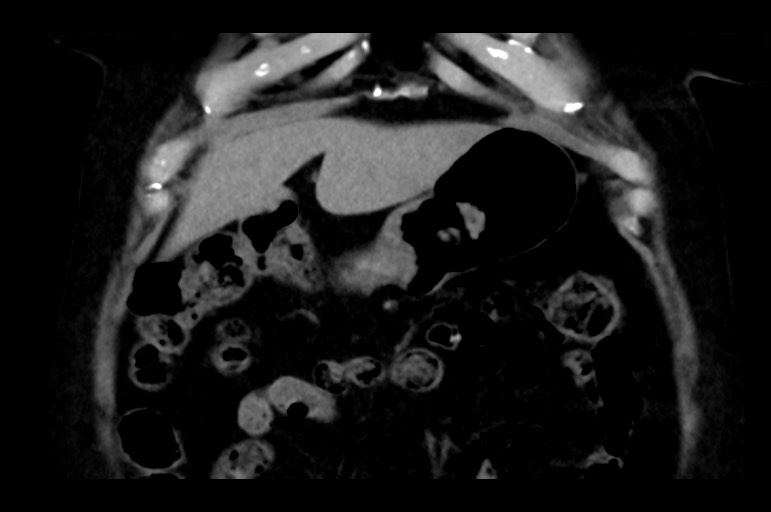 Adrenal cortical carcinoma (Radiopaedia 64017-72769 Coronal non-contrast 13).jpg