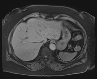 Adrenal cortical carcinoma (Radiopaedia 64017-72770 Axial T1 fat sat 10).jpg