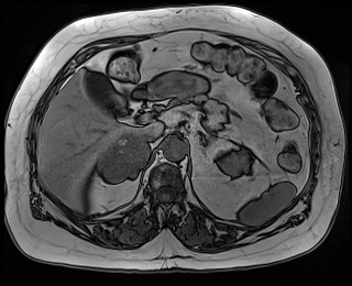 File:Adrenal cortical carcinoma (Radiopaedia 64017-72770 Axial T1 out-of-phase 25).jpg