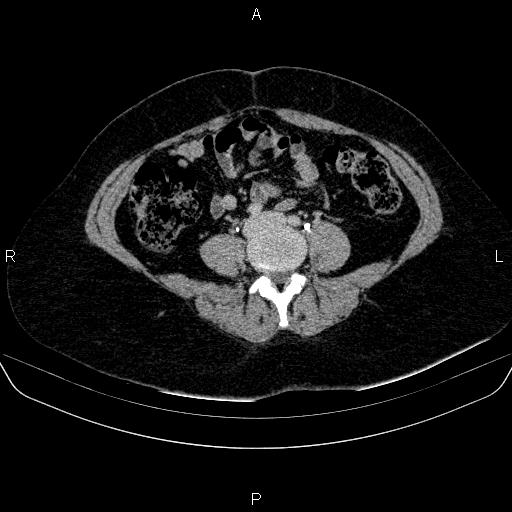 Adrenal cortical carcinoma (Radiopaedia 84882-100379 Axial C+ delayed 58).jpg