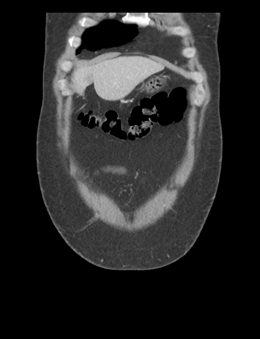 Adrenal cyst (Radiopaedia 45625-49777 Coronal C+ portal venous phase 13).png