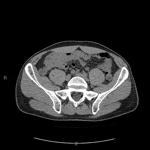 Adrenal cystic lymphangioma (Radiopaedia 83161-97534 Axial non-contrast 69).jpg
