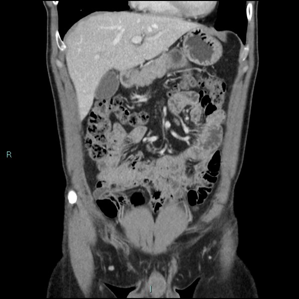 Adrenal cystic lymphangioma (Radiopaedia 83161-97534 Coronal C+ portal venous phase 23).jpg