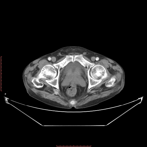 Adrenal hemangioma (Radiopaedia 68923-78668 Axial C+ portal venous phase 68).jpg