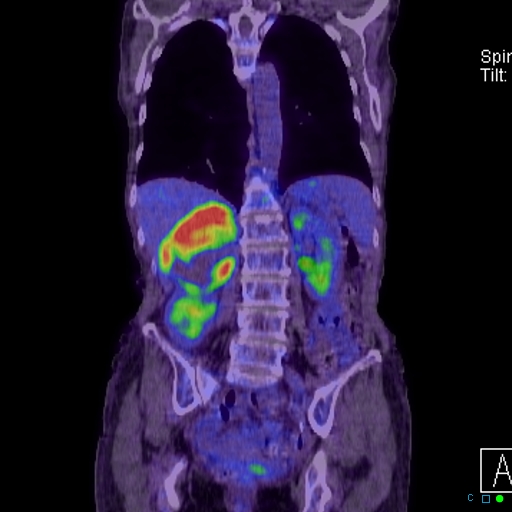 File:Adrenal metastasis from small cell lung cancer (Radiopaedia 19133-19109 Coronal 21).jpg