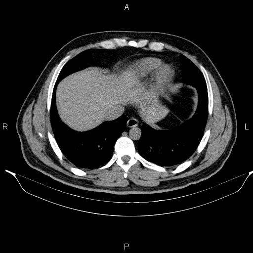 Adrenal myelolipoma (Radiopaedia 84321-99619 Axial non-contrast 13).jpg