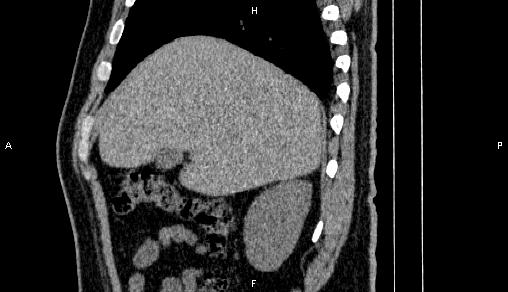 Adrenal myelolipoma (Radiopaedia 84321-99619 Sagittal non-contrast 25).jpg