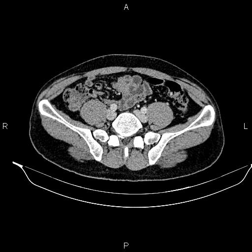 Adrenal myelolipoma (Radiopaedia 87794-104246 Axial renal cortical phase 76).jpg