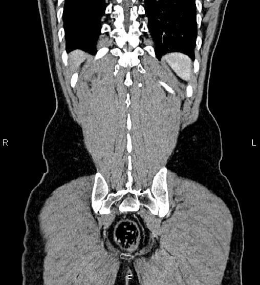 Adrenal myelolipoma (Radiopaedia 87794-104246 Coronal renal cortical phase 58).jpg