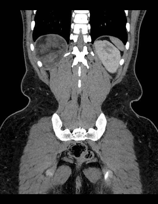 Adrenal myelolipoma - bilateral (Radiopaedia 74805-85810 Coronal C+ portal venous phase 78).jpg